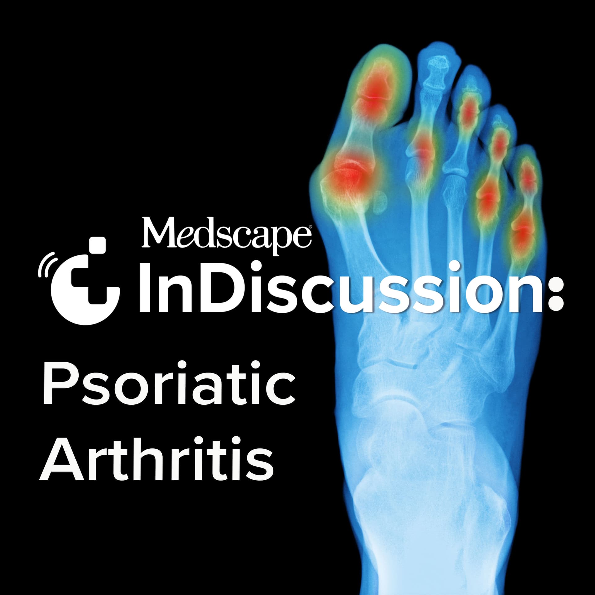 Medscape InDiscussion: Psoriatic Arthritis - Podcasts
