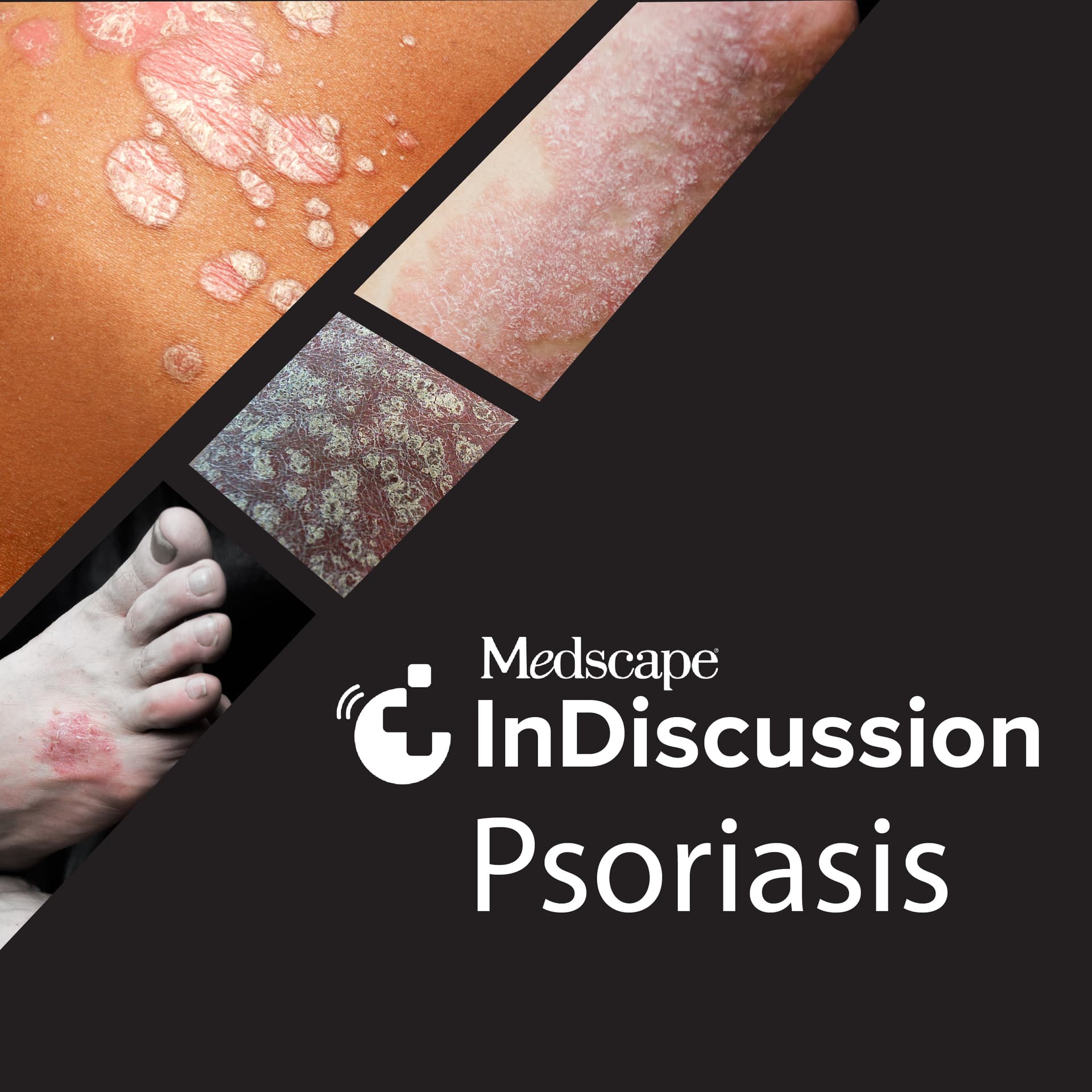 Medscape InDiscussion: Psoriasis - Podcasts