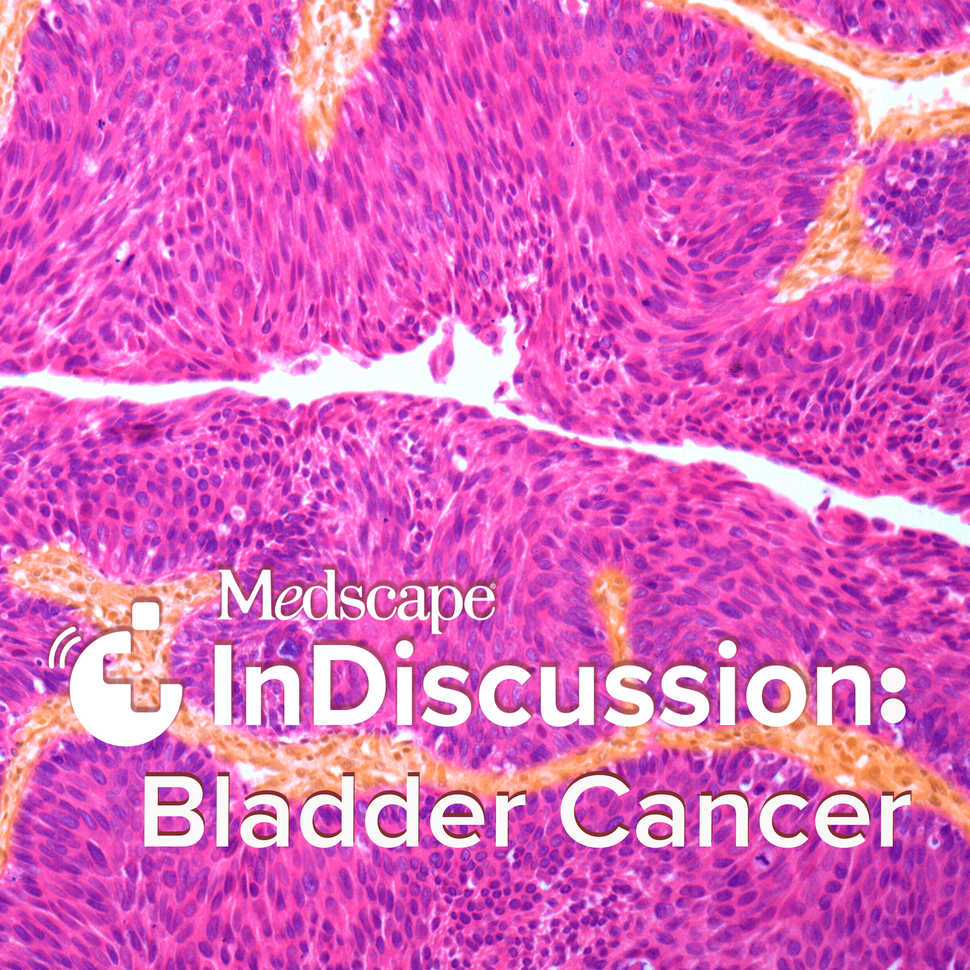 Medscape InDiscussion: Bladder Cancer - Podcasts