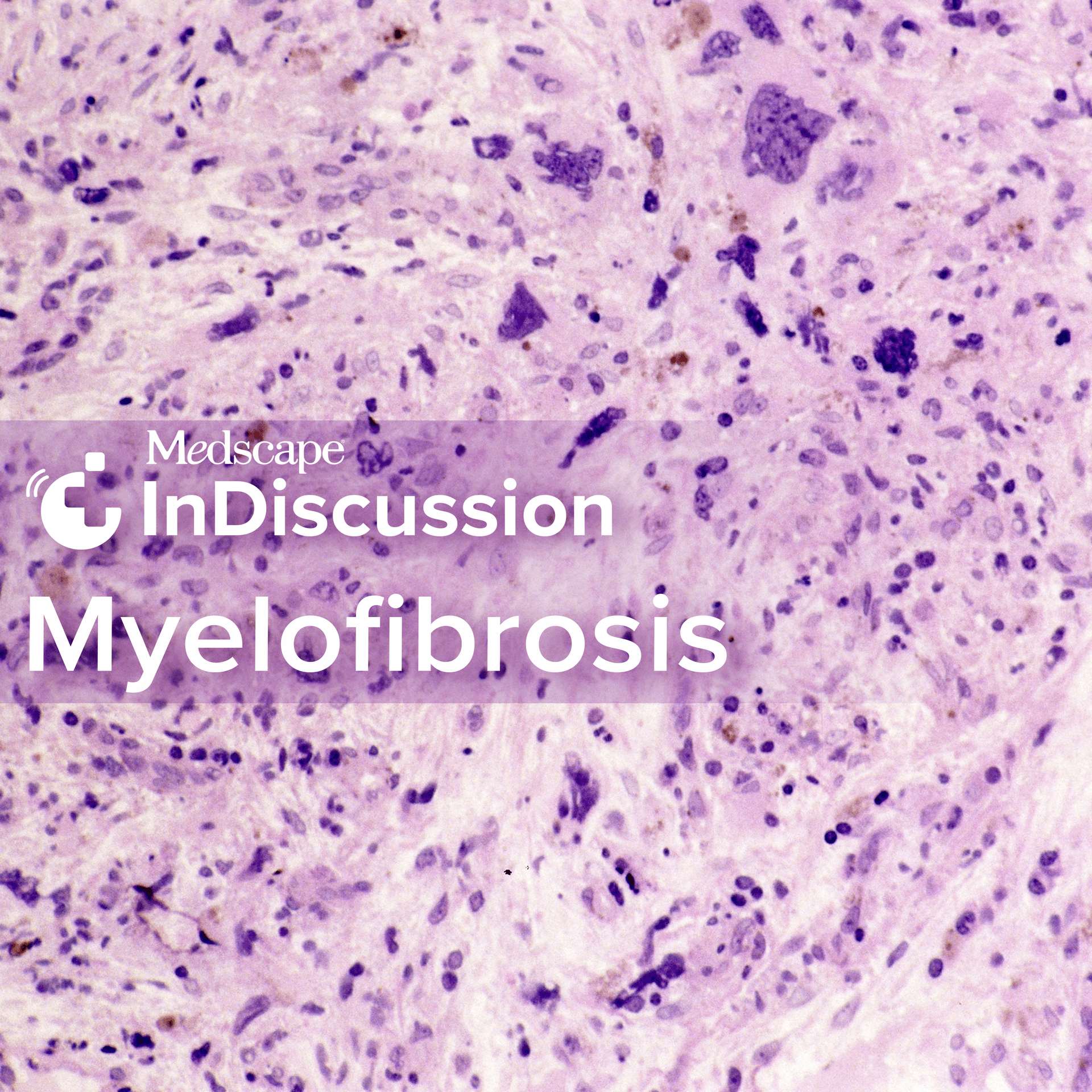 Medscape InDiscussion: Myelofibrosis - Podcasts
